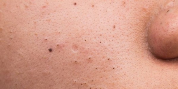 
            Как избавиться от чёрных точек        
